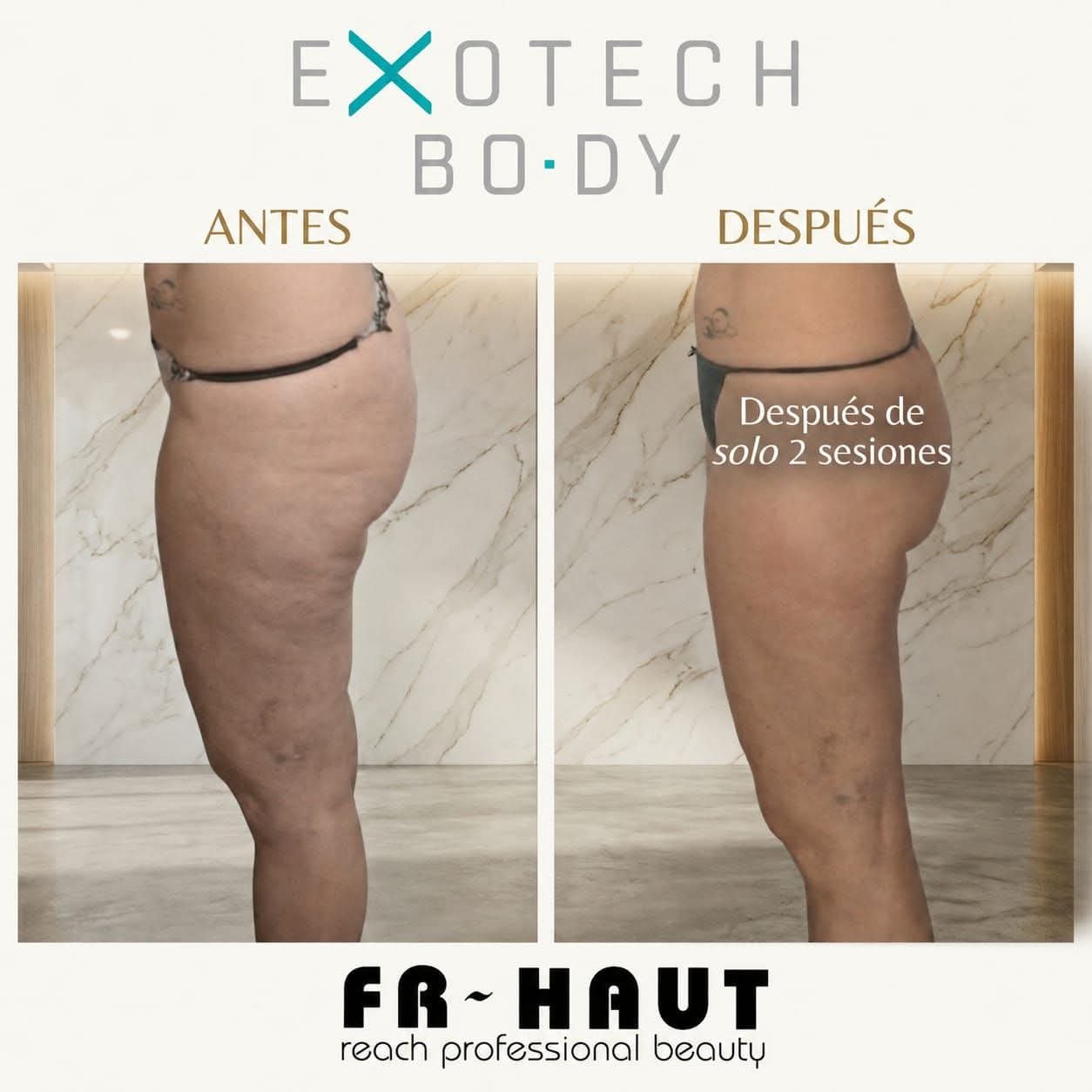 Antes y después de un tratamiento con Exotech Body de Fr~haut, resultados tras solo 2 sesiones